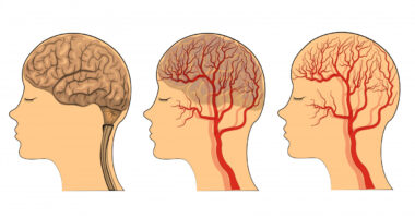 atypical headaches