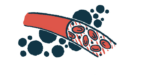 A close-up illustration of a blood vessel provides views inside and out.